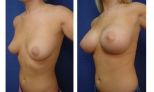 breast augmentation revision - left lateral view