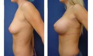 breast augmentation revision - left view