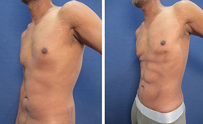 hd liposuction men before after mowlavi