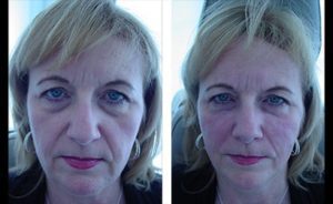 Facial fillers Before and After