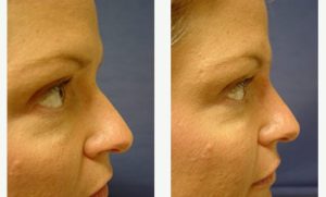 Facial fillers Before and After