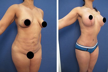 Liposuction - Waistline Narrowing - Dr. Laguna
