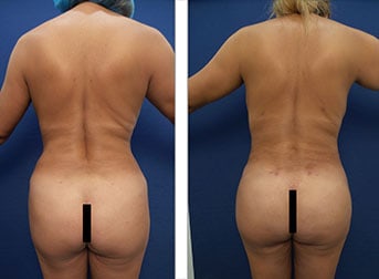 Buttocks Downsizing and Reshaping Image