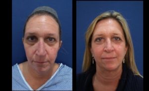 facial resurfacing mowlavi