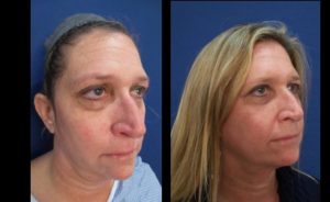 facial resurfacing mowlavi