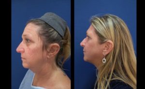 facial resurfacing mowlavi