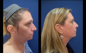 facial resurfacing mowalvi