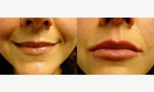 Facial fillers Before and After