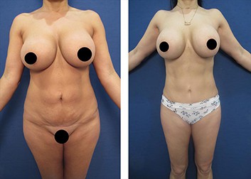 dr.laguna hd liposuction before after