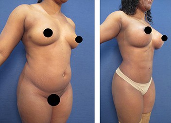 dr.laguna hd liposuction before after