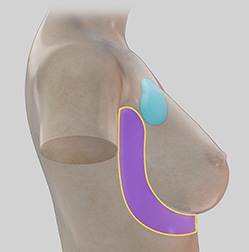 liposuction complications chest