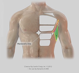 liposuction complications chest