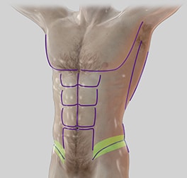 liposuction complications anterior flanks