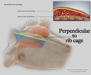 liposuction complications chest