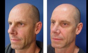 dr.laguna rhinoplasty before after