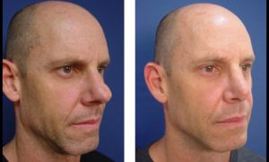 dr.laguna rhinoplasty before after