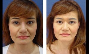 dr.laguna rhinoplasty before after