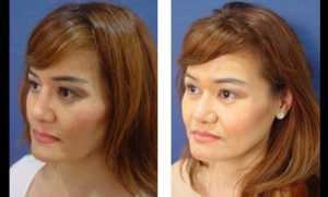 dr.laguna rhinoplasty before after