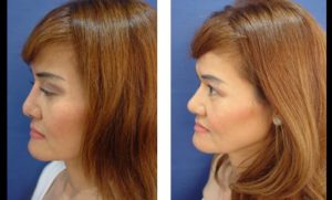 dr.laguna rhinoplasty before after