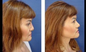 dr.laguna rhinoplasty before after