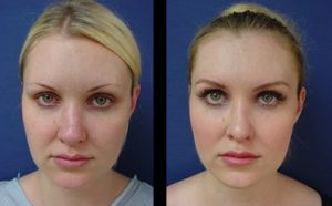 rhinoplasty revision to correct nasal contour - front view