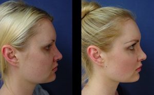 dr.laguna rhinoplasty before after