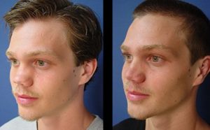 dr.laguna rhinoplasty before after