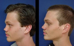 dr.laguna rhinoplasty before after