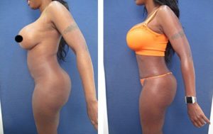 hd body contouring revision before after