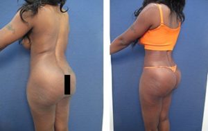 hd body contouring before after