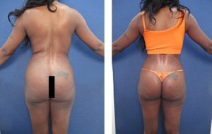 hd body contouring revision before after