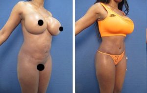 hd body contouring revision before after