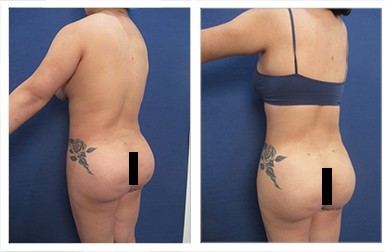 Before & After - Brazilian Butt Lift Revision - in Orange County