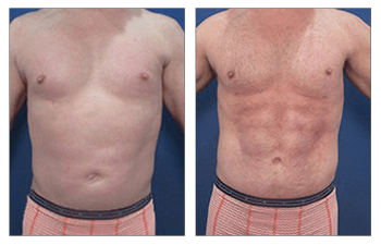 high definition liposuction for men procedure - front view