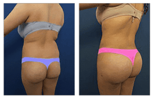 before and after liposuction consultation