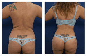 before and after liposuction consultation