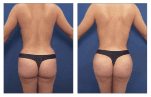before and after liposuction consultation