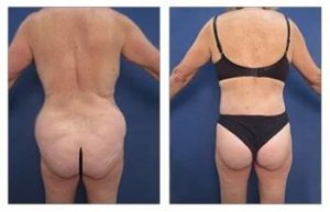 VASER hd liposuction with BBL procedure - back view