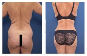 Before and after BBL procedure - back view