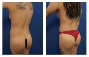 BBL and hd liposuction procedure - back left view