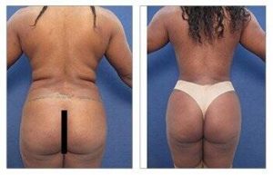 35-year old female following VASER high definition liposuction and BBL - back view