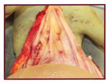 lymphoma image