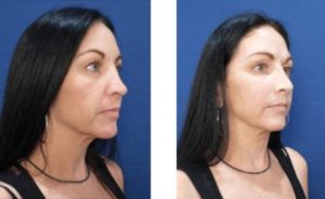 Facial fillers Before and After