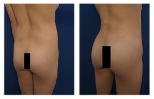 Liposuction