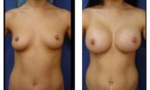 breast augmentation procedure - front view