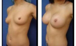 breast augmentation procedure - left lateral view