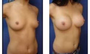 breast augmentation procedure - right lateral view