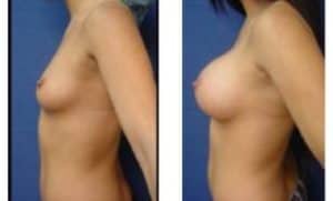 breast augmentation procedure - left view