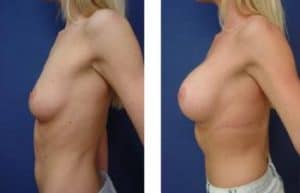 breast augmentation procedure - left view