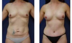 breast augmentation surgery - front view